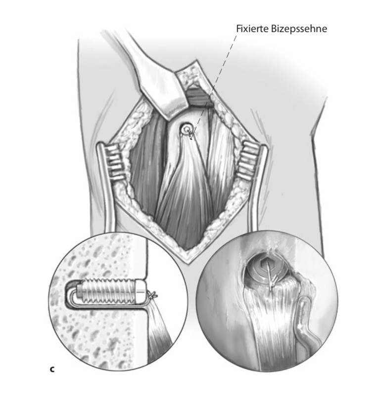 verletzungen der langen bizepssehne