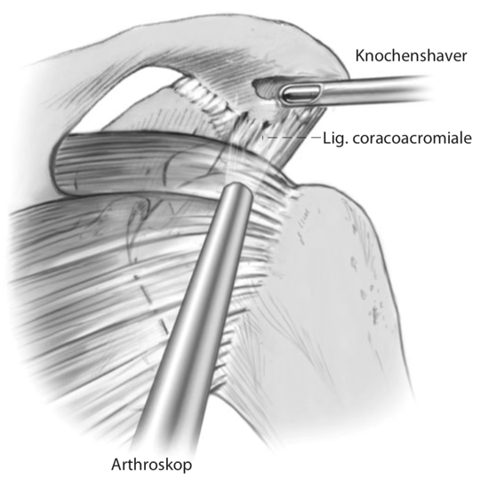 Kalkschulter